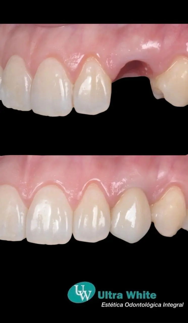 Caso real: antes y después de un implante dental — Ultra White