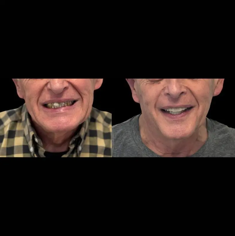 Caso real: sonrisa de paciente antes y después del tratamiento — Ultra White