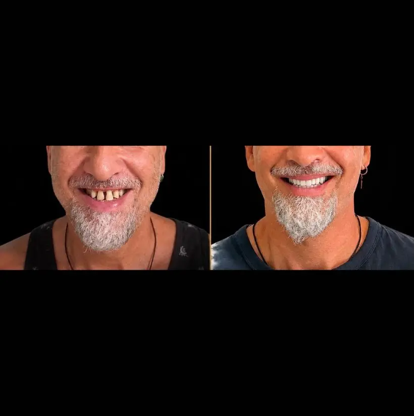 Caso real: rehabilitación de la sonrisa antes y después — Ultra White