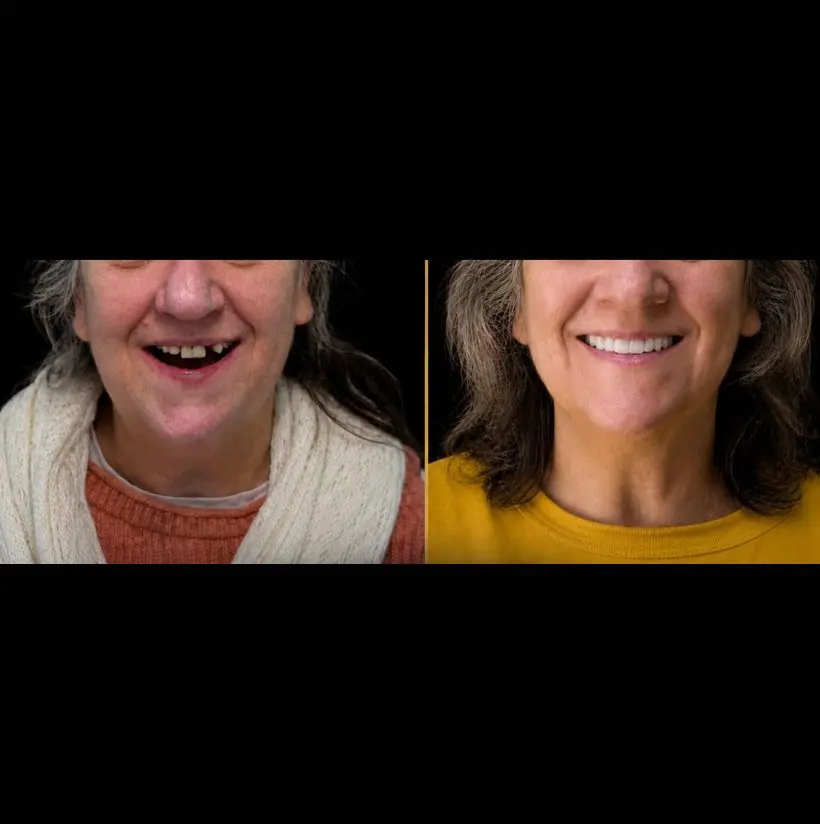 Caso real: sonrisa recuperada antes y después — Ultra White