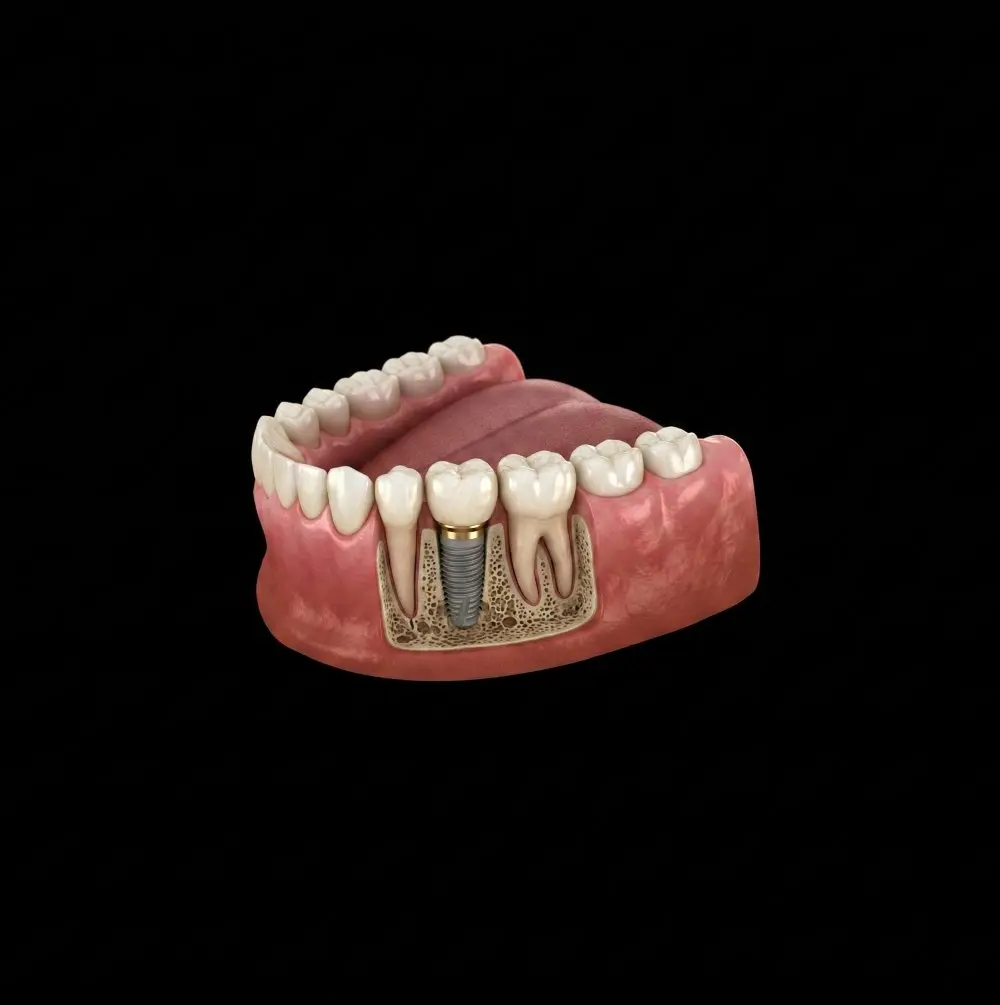 Representación 3D de un implante dental de titanio colocado en el hueso